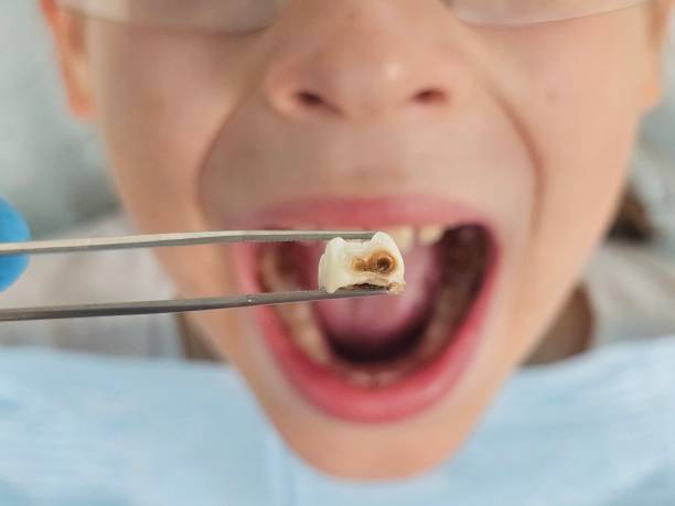 Best Emergency Wisdom Tooth Extraction in Maywood Park, OR